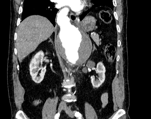 File:Abdominal aortic aneurysm (Radiopaedia 67117-76452 Coronal C+ arterial phase 56).jpg
