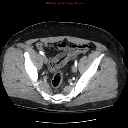 File:Abdominal aortic aneurysm (Radiopaedia 8190-9038 Axial C+ arterial phase 70).jpg