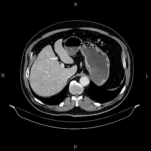 File:Abdominal aortic aneurysm (Radiopaedia 83094-97462 Axial renal cortical phase 73).jpg