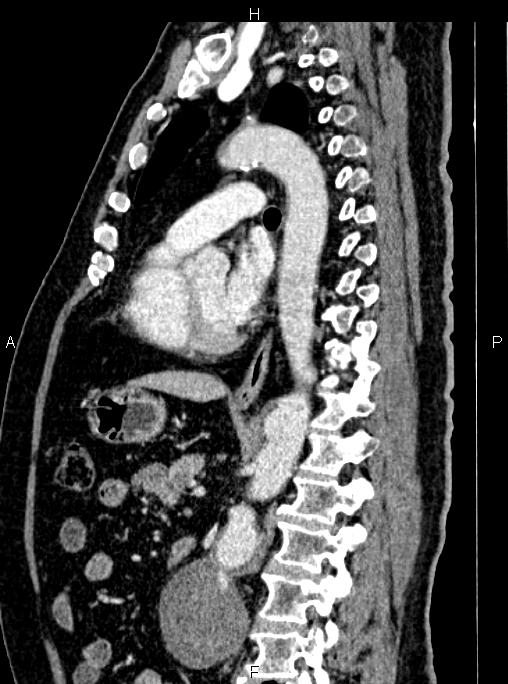 Abdominal aortic aneurysm (Radiopaedia 83094-97462 Sagittal renal cortical phase 71).jpg