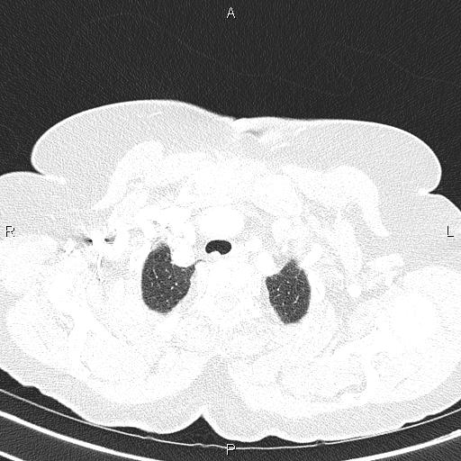 Abdominal aortic aneurysm (Radiopaedia 85063-100606 Axial lung window 13).jpg