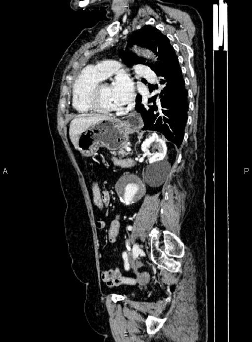 Abdominal aortic aneurysm (Radiopaedia 85063-100606 Sagittal C+ arterial phase 54).jpg