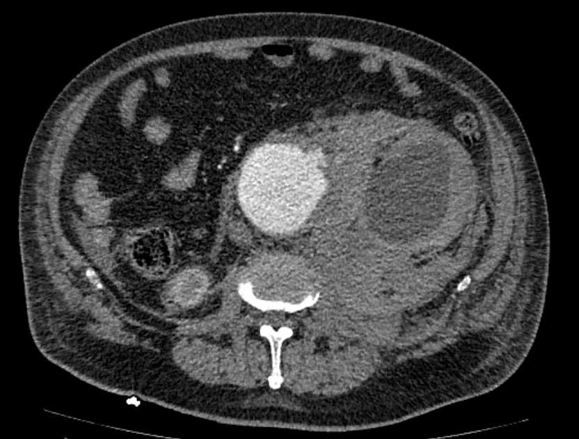 Abdominal aortic aneurysm rupture (Radiopaedia 54179-60362 Axial C+ arterial phase 33).jpg