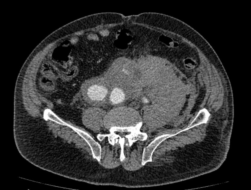 Abdominal aortic aneurysm rupture (Radiopaedia 54179-60362 Axial C+ arterial phase 41).jpg