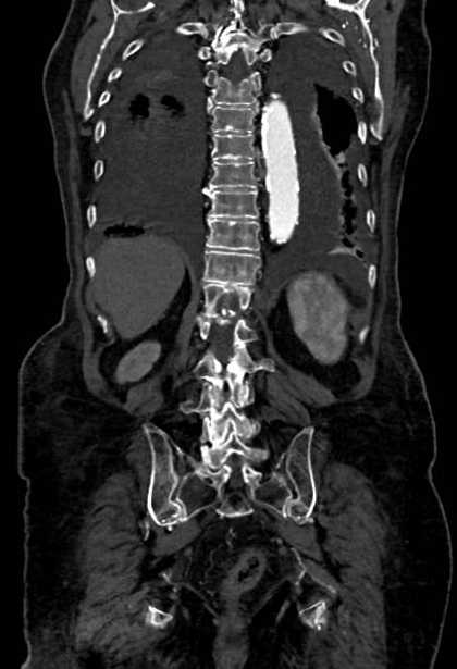 Abdominal aortic aneurysm with thrombus fissuration (Radiopaedia 73192-83919 Coronal C+ arterial phase 71).jpg