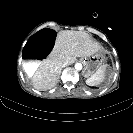 File:Abdominal collection due to previous cecal perforation (Radiopaedia 80831-94320 Axial C+ portal venous phase 33).jpg