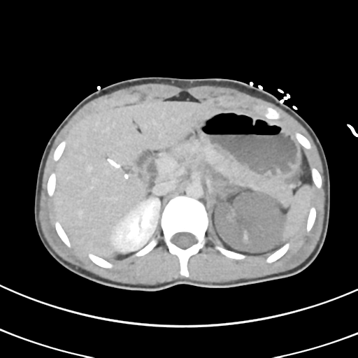 File:Abdominal multi-trauma - devascularised kidney and liver, spleen and pancreatic lacerations (Radiopaedia 34984-36486 Axial C+ delayed 21).png