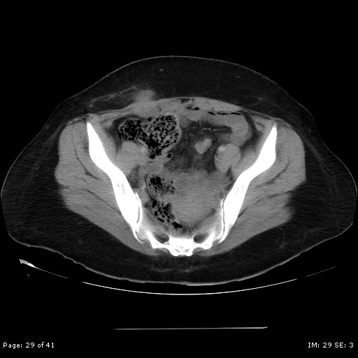 File:Abdominal wall endometriosis (Radiopaedia 25723-25885 Axial C+ portal venous phase 29).jpg