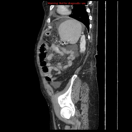 Abdominal wall hematoma (Radiopaedia 9427-10112 Sagittal C+ portal venous phase 24).jpg