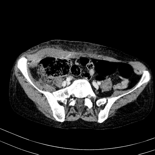 File:Abdominal wall hematoma with active bleeding (Radiopaedia 83915-99117 Axial C+ portal venous phase 91).jpg