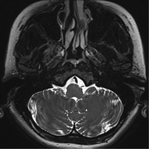 Abducens nerve palsy (Radiopaedia 51069-56648 Axial T2 fat sat 3).png