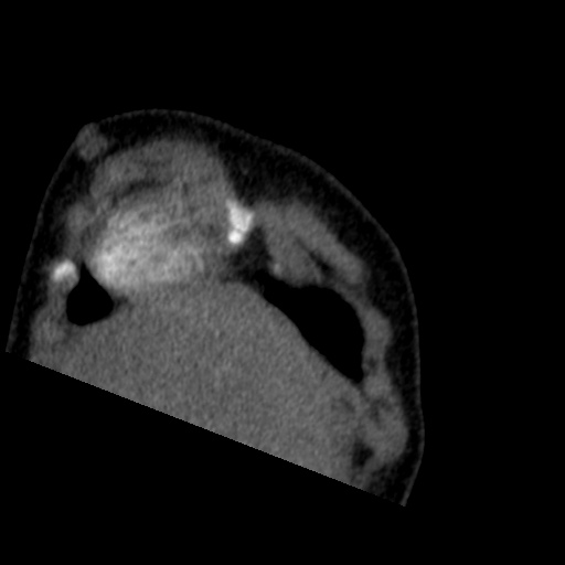 File:Aberrant left pulmonary artery (pulmonary sling) (Radiopaedia 42323-45435 Coronal C+ CTPA 26).jpg