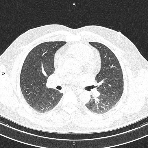 File:Aberrant right subclavian artery (Radiopaedia 87093-103354 Axial lung window 53).jpg
