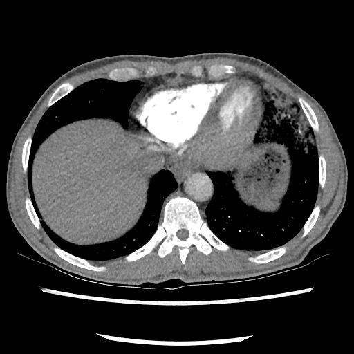 Accessory left horizontal fissure with lingular pneumonia (Radiopaedia 53763-59843 Axial C+ CTPA 73).jpg