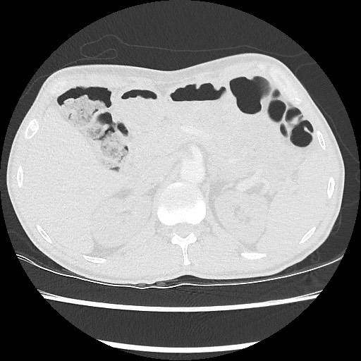 Accessory left horizontal fissure with lingular pneumonia (Radiopaedia 53763-59843 Axial lung window 59).jpg