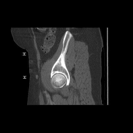 File:Acetabular fracture (Radiopaedia 13193-13212 Sagittal bone window 21).jpg