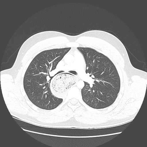 File:Achalasia (Radiopaedia 52507-58417 Axial lung window 25).jpg