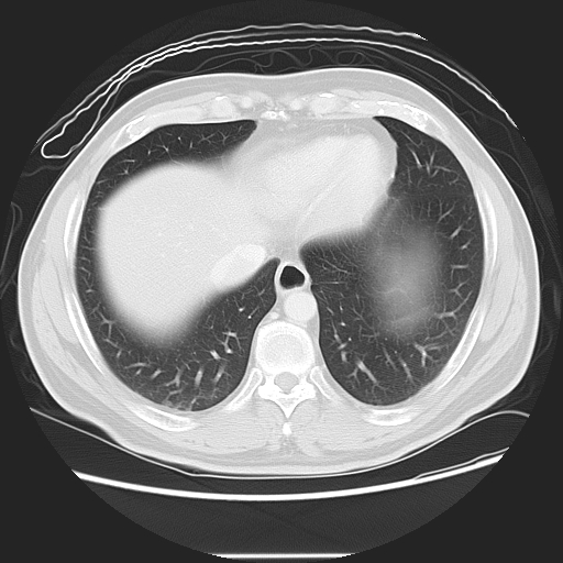 Achalasia (Radiopaedia 8831-9629 Axial lung window 46).jpg