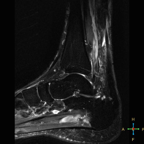 File:Achilles tendon complete tear (Radiopaedia 22834-22854 Sagittal STIR 11).jpg