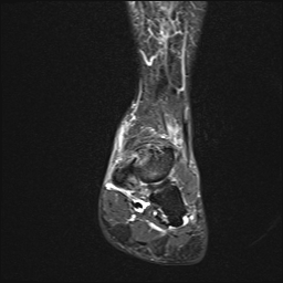 File:Achilles tendon tear (Radiopaedia 77615-89819 Coronal STIR 12).jpg