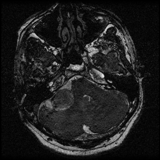 File:Acoustic schwannoma (Radiopaedia 39170-41387 Axial FIESTA 55).png