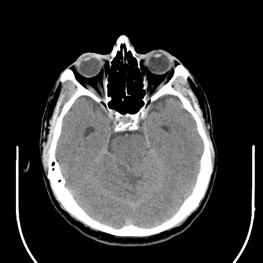 File:Acoustic schwannoma (Radiopaedia 39170-41388 Axial non-contrast 17).png