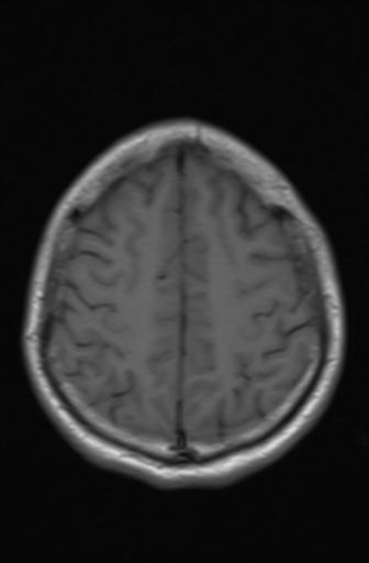 Acoustic schwannoma - probable (Radiopaedia 20386-20292 Axial T1 15).jpg