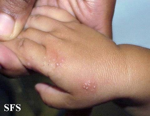 Acropustulosis Infantile (Dermatology Atlas 2).jpg