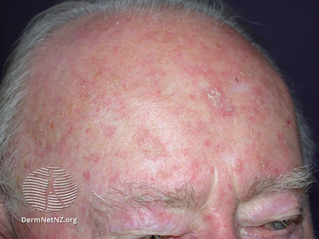 File:Actinic keratoses (DermNet NZ lesions-sk6).jpg