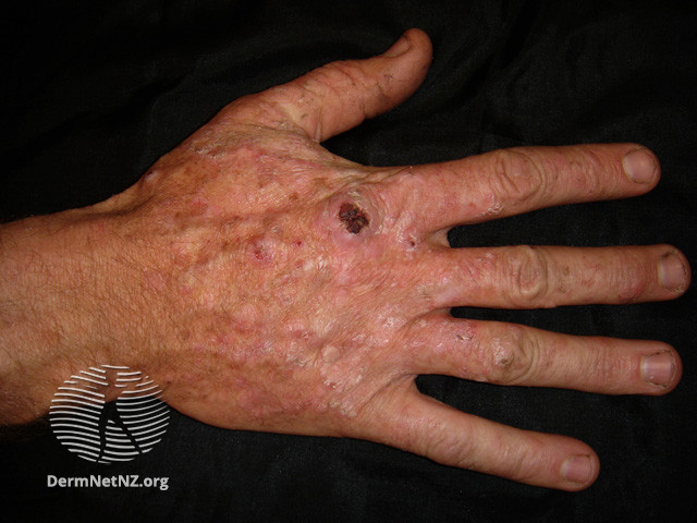 File:Actinic keratoses affecting the hands (DermNet NZ lesions-ak-hands-288).jpg