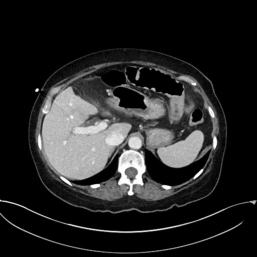 Active Crohn disease (Radiopaedia 59394-66750 Axial C+ portal venous phase 18).jpg