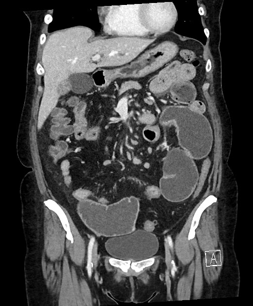 Active Crohn disease (Radiopaedia 59394-66750 Coronal C+ portal venous phase 30).jpg