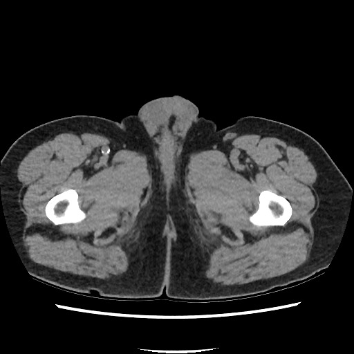 Active colonic bleed on CT (Radiopaedia 49765-55025 Axial non-contrast 94).jpg