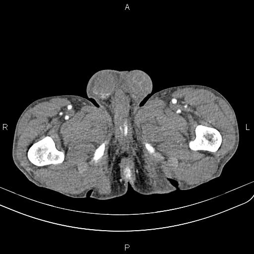 Active crohn disease (Radiopaedia 87133-103397 Axial C+ arterial phase 114).jpg