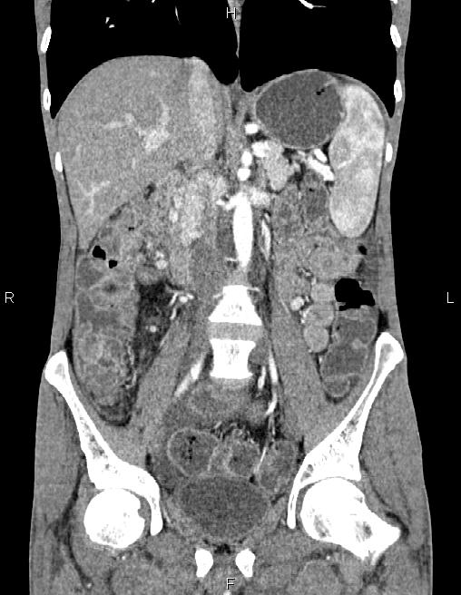 Active crohn disease (Radiopaedia 87133-103397 Coronal C+ arterial phase 33).jpg