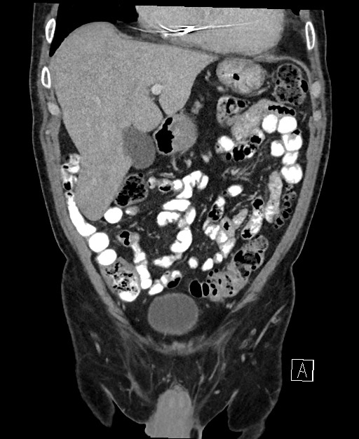 Active lower gastrointestinal bleeding - diverticular (Radiopaedia 61203-69106 Coronal C+ portal venous phase 43).jpg