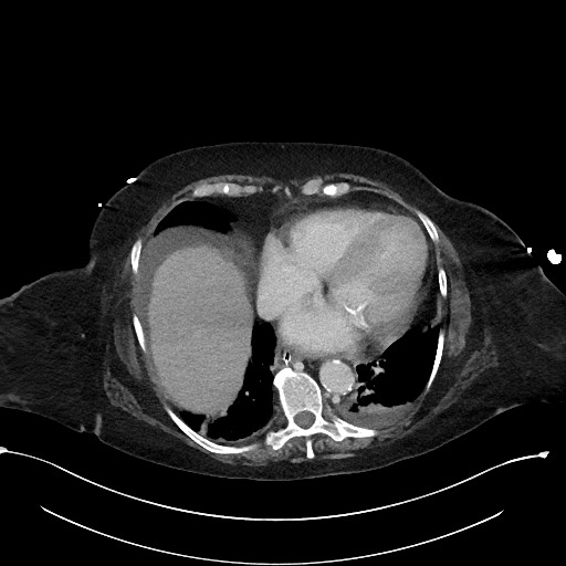 File:Active renal extravasation with large subcapsular and retroperitoneal hemorrhage (Radiopaedia 60975-68796 Axial 345).jpg
