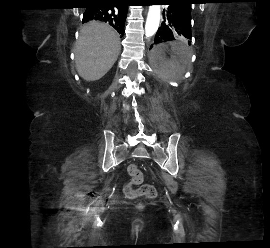 Active renal extravasation with large subcapsular and retroperitoneal hemorrhage (Radiopaedia 60975-68796 Coronal C+ arterial phase 116).jpg