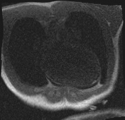 Active right ventricular cardiac sarcoidosis (Radiopaedia 55596-62100 Axial Dynamic perfusion scan MOCO 4).jpg