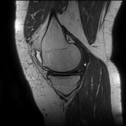 File:Acute-on-chronic transient lateral patellar dislocation with trochlear dysplasia (Radiopaedia 84099-99349 Sagittal PD 52).jpg