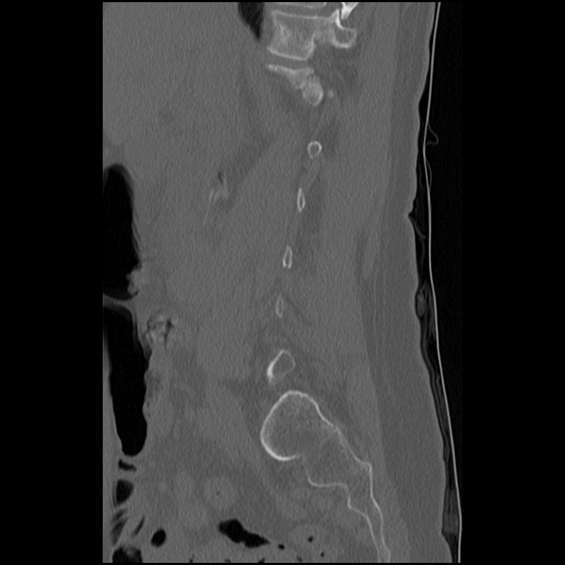 Acute Schmorl's node (Radiopaedia 83276-102365 Sagittal bone window 54).jpg
