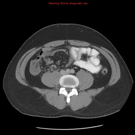 File:Acute appendicitis (Radiopaedia 10498-10973 Axial C+ portal venous phase 11).jpg