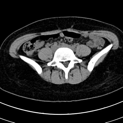 Acute appendicitis (Radiopaedia 30261-30888 Axial non-contrast 60).jpg