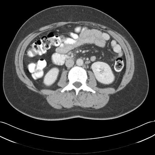 Acute appendicitis (Radiopaedia 30297-30934 Axial C+ portal venous phase 39).jpg