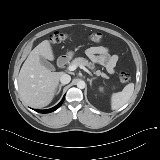 Acute appendicitis (Radiopaedia 36611-38177 Axial C+ portal venous phase 30).png