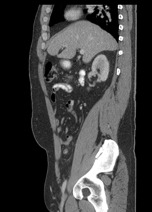 Acute appendicitis (Radiopaedia 48511-53463 Sagittal C+ portal venous phase 53).jpg