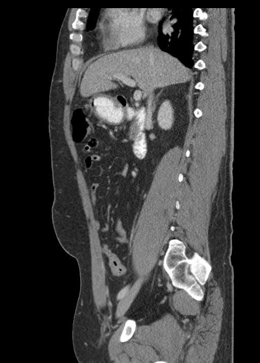 Acute appendicitis (Radiopaedia 48511-53463 Sagittal C+ portal venous phase 59).jpg