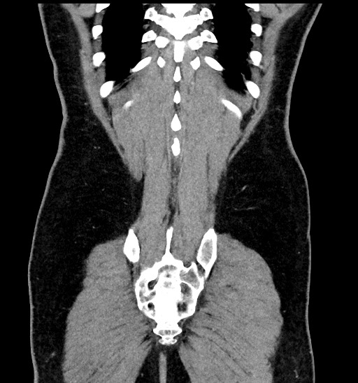 Acute appendicitis (Radiopaedia 77016-88960 Coronal C+ portal venous phase 85).jpg