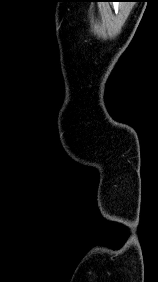 Acute appendicitis (Radiopaedia 77016-88960 Sagittal C+ portal venous phase 2).jpg