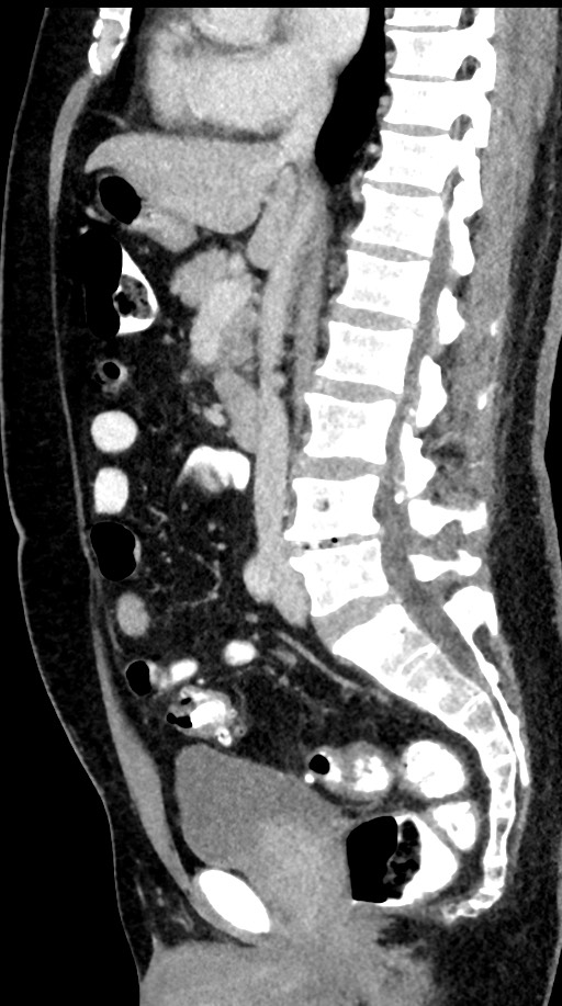 Acute appendicitis (Radiopaedia 77016-88960 Sagittal C+ portal venous phase 60).jpg